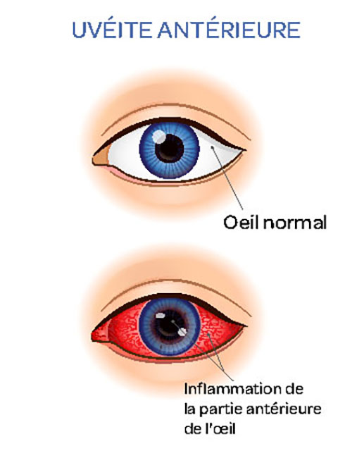 uvéite