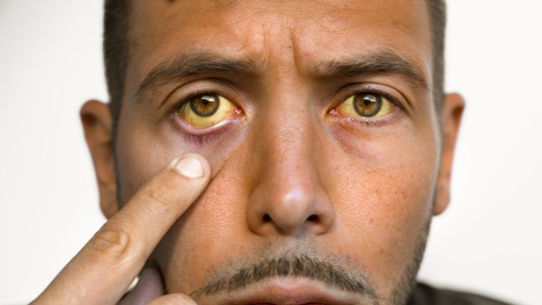 vaccin hépatite A à Paris CVI Elsan : image d'un jeune homme dont le teint et les yeux sont jaunes.