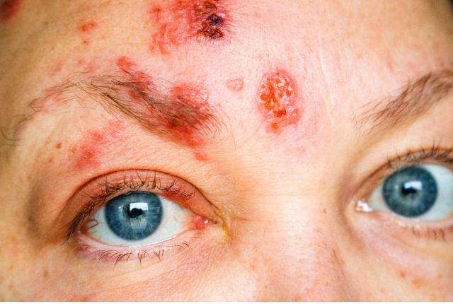 Zona ophtalmique : parmi les premiers symptômes figurent des éruptions cutanées sur le front, l’aile du nez et la paupière.