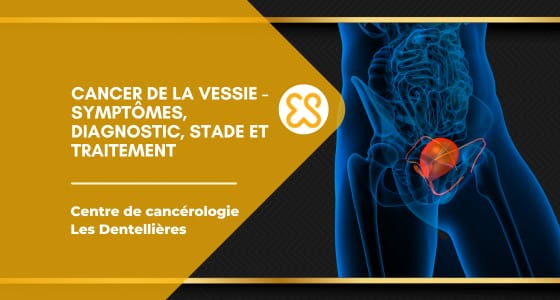 Cancer de la vessie – Symptômes, diagnostic, stade et traitement