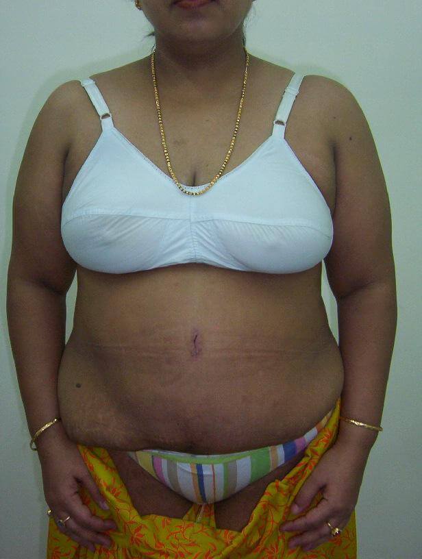 Liposuction after result one