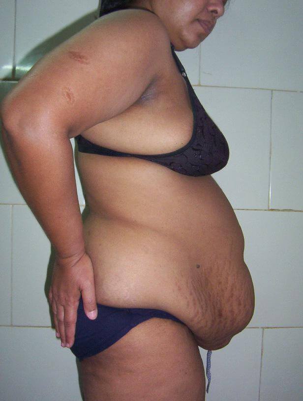 Liposuction before result two