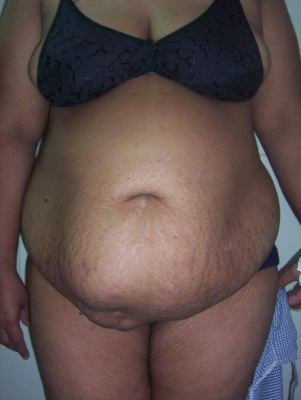 Liposuction before result one