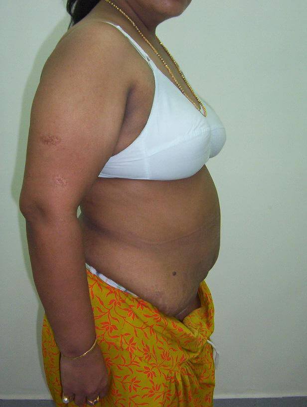 Liposuction after result two