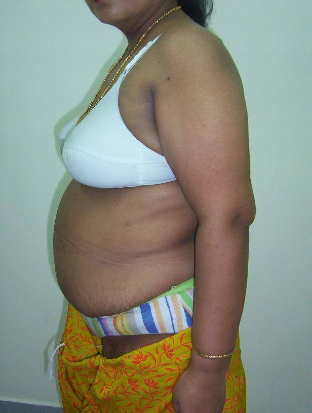 Liposuction after result three