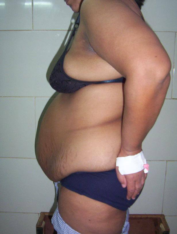 Liposuction before result three