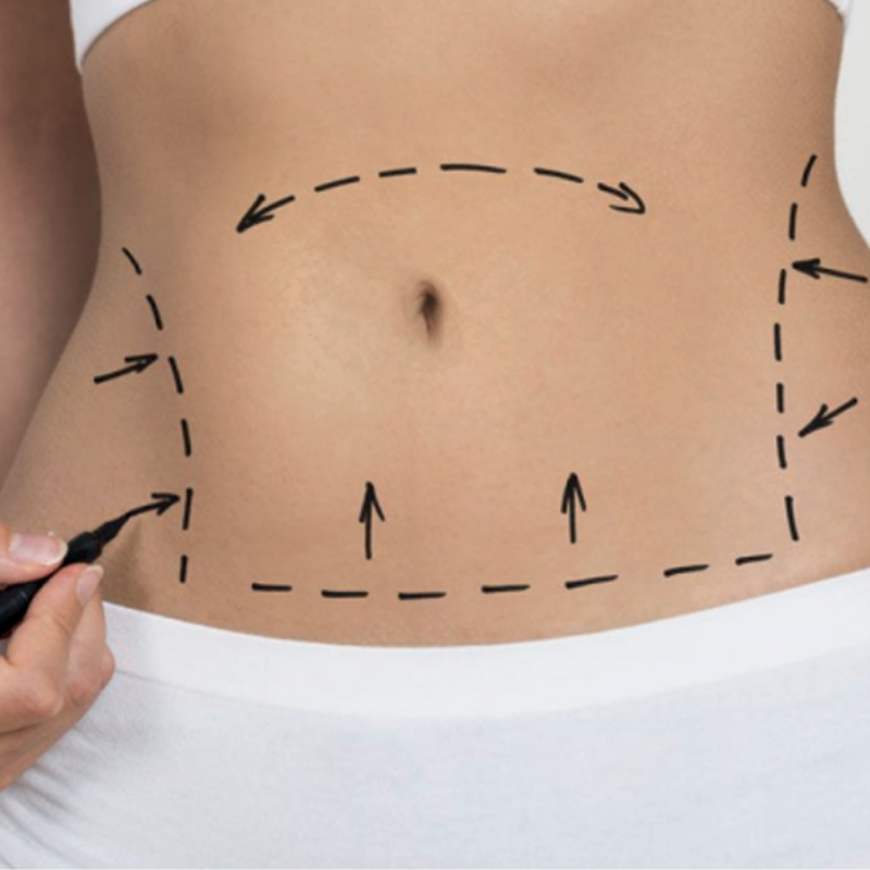 Paciente con resultados de Abdominoplastia.