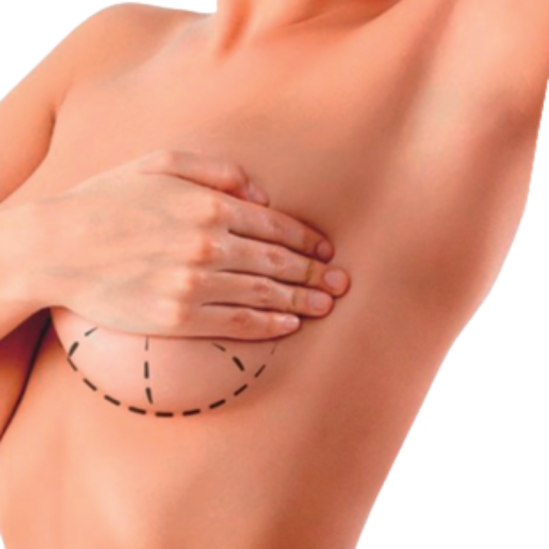 Paciente con resultados de Mamoplastia.