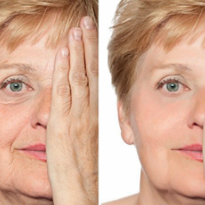 Paciente con resultados de Rinoplastia.