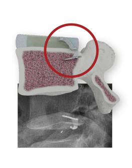 Barricaid procedure