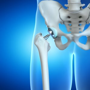 Taking the Pain Out of Hip-Replacement Surgery