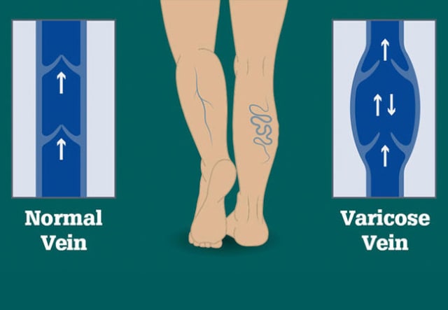 Your Guide To The Best Compression Stockings For Varicose Veins