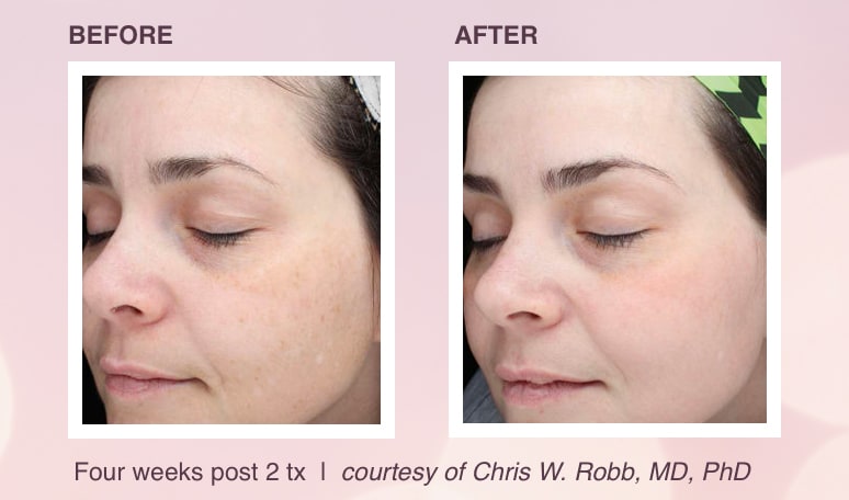 Laser Skin Treatments