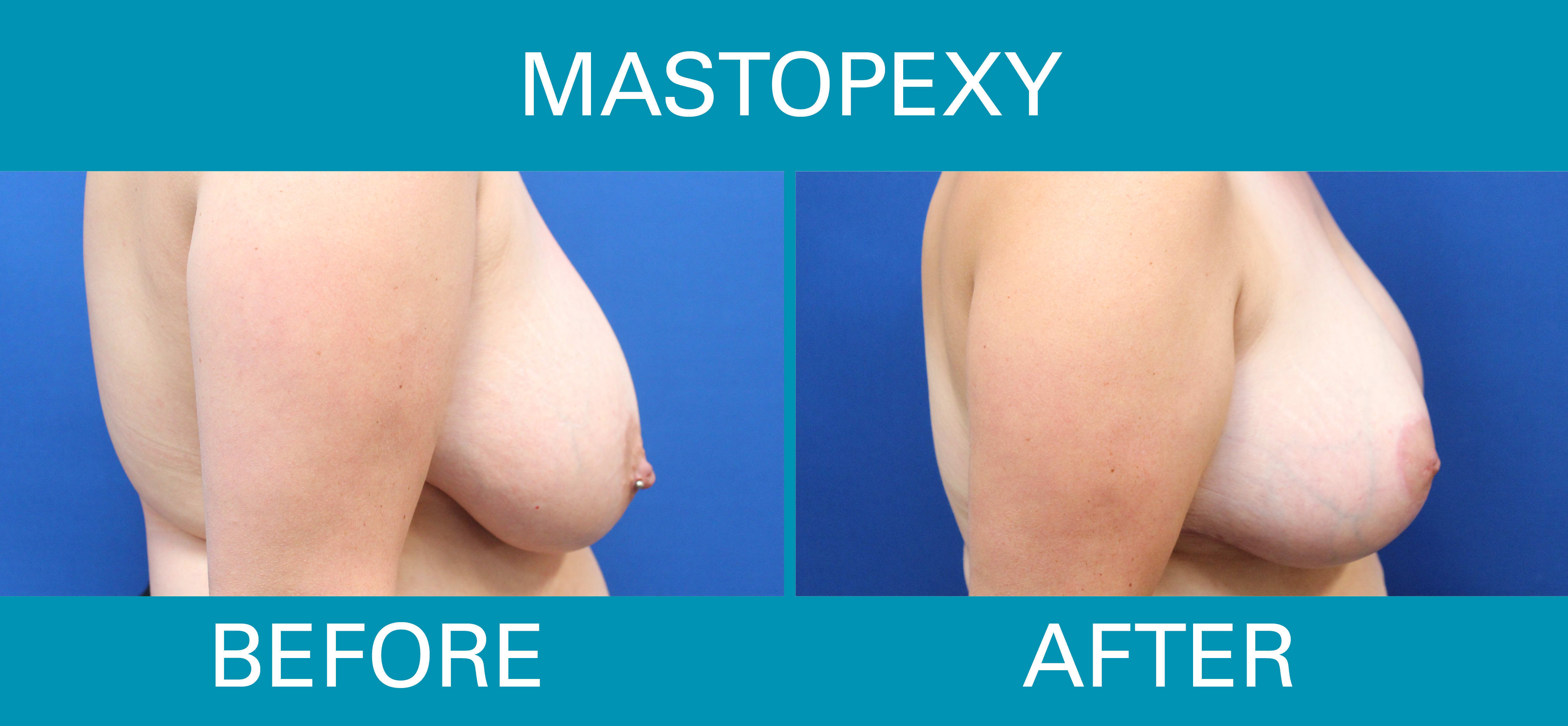 Details About Breast Lift (Mastopexy) Surgery