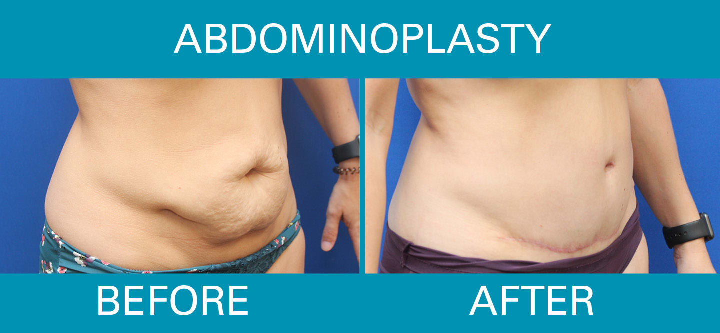 Patient 176763660  Tummy Tuck Revision by Dr. Booth Before