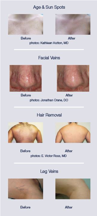 Laser Hair Removal and Skin Treatment