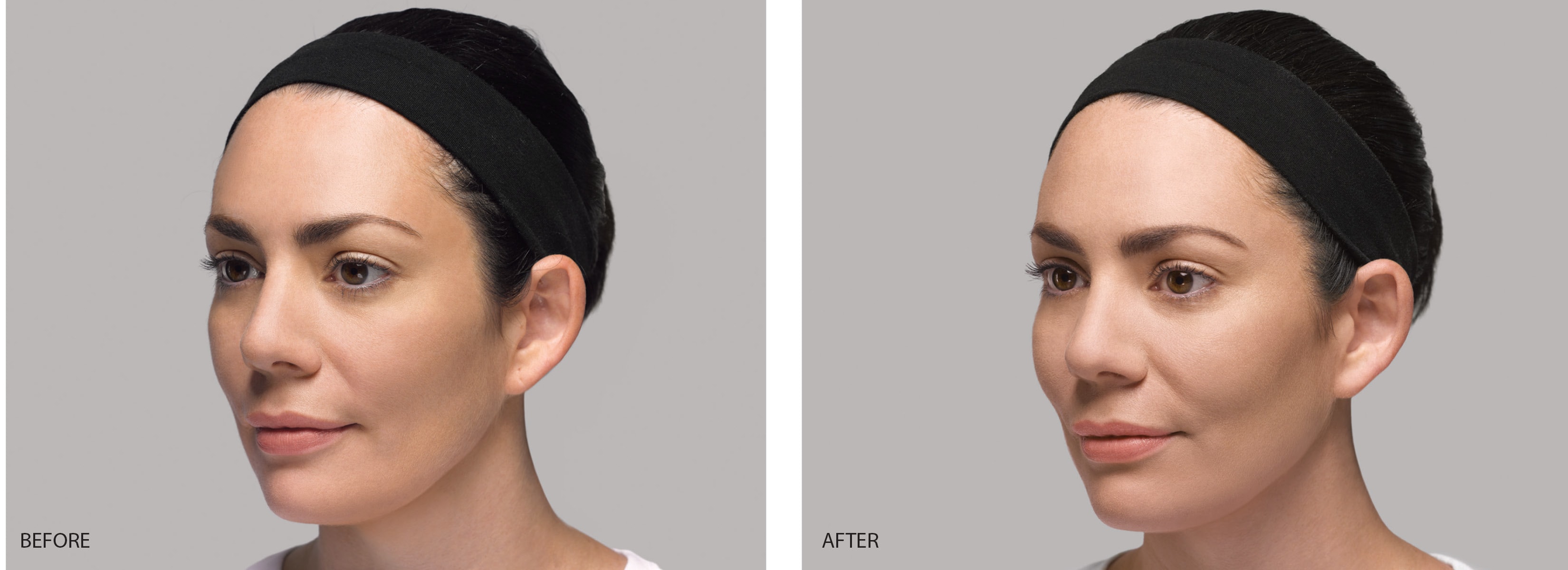 restylane lyft cheek contour