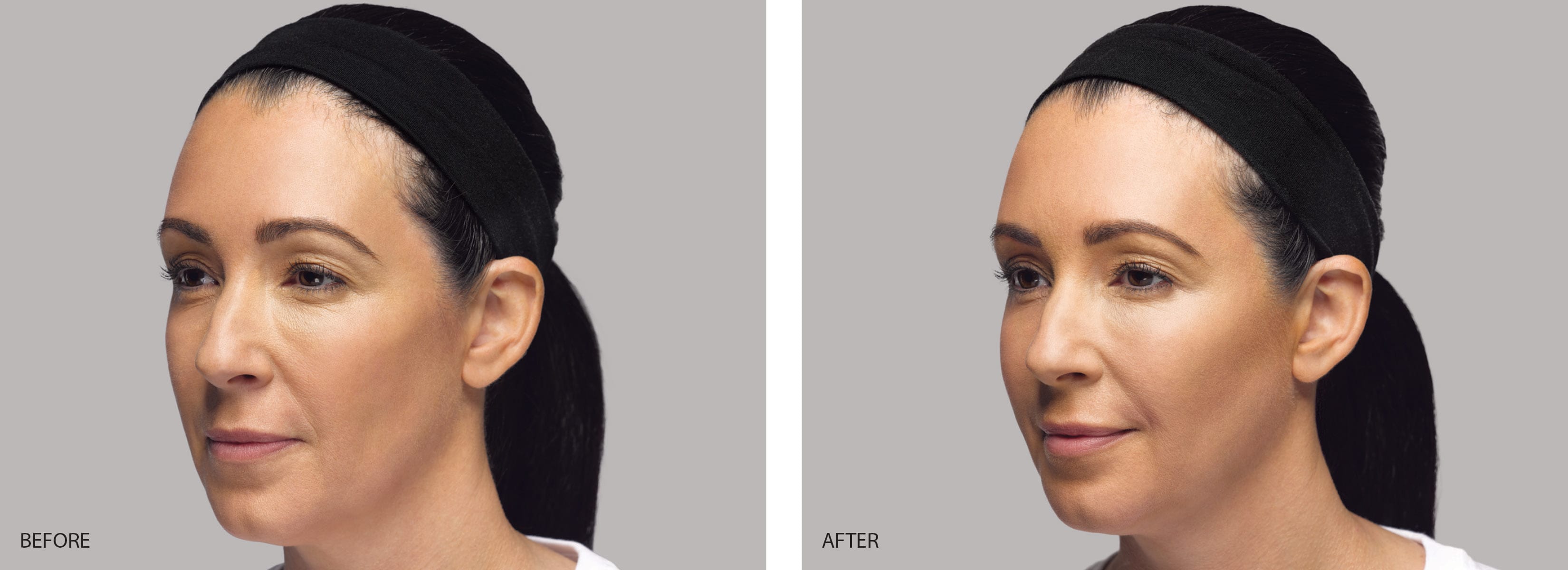 restylane lyft cheek contour