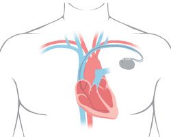 Drawing of an anatomical heart in a man's chest with a monitor lead.