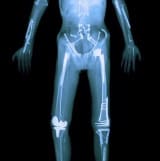 Xray of extreme sport athlete Travis Pastrana