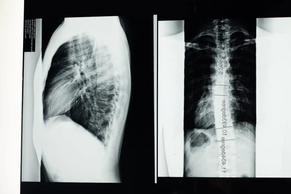 Radiographie et capsulite rétractile de l’épaule : un guide complet