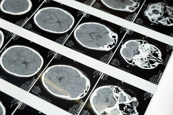 Symptômes d'un accident vasculaire cérébral : Comment les reconnaître ?