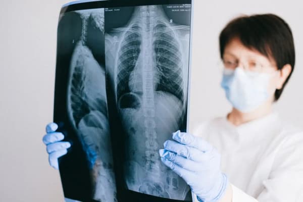 Gérer l'arthrose de la hanche : comprendre et traiter la coxarthrose