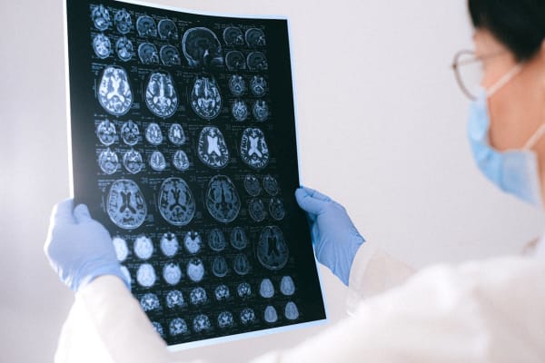 Nouveau traitement prometteur pour la maladie de Parkinson