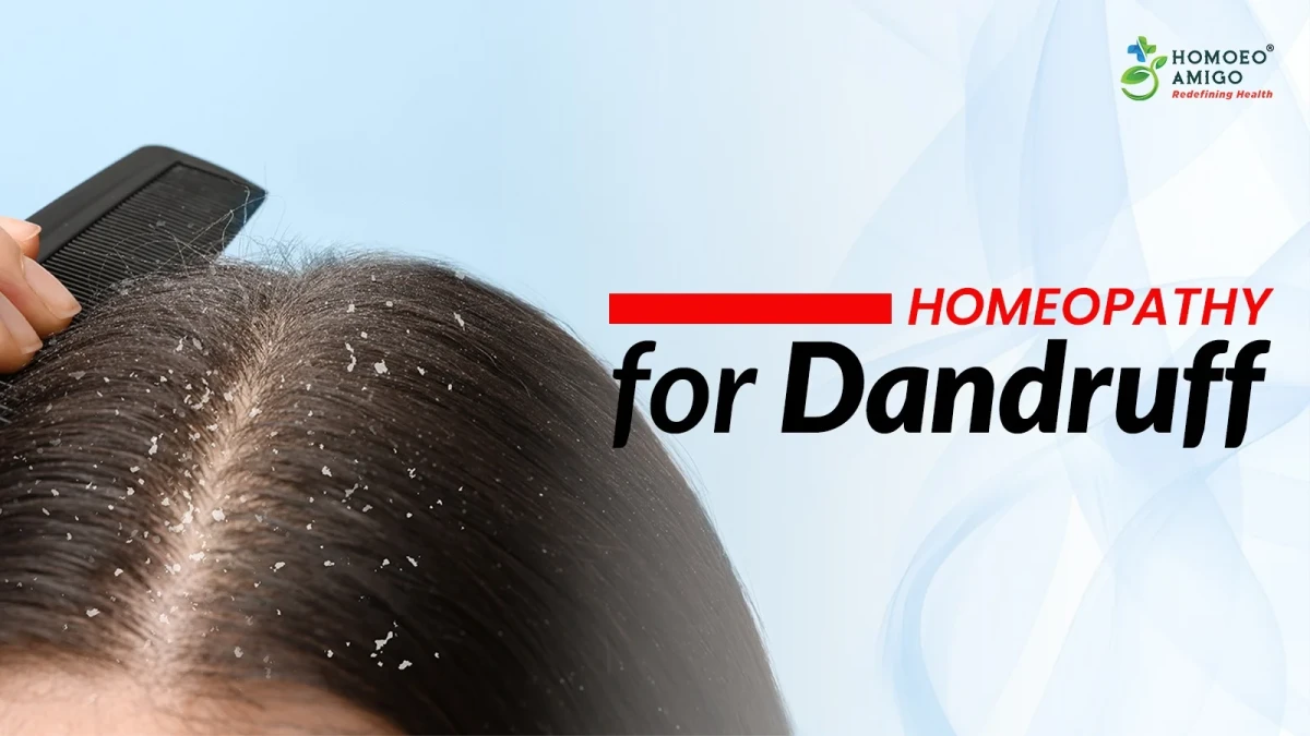 Homeopathy for Dandruff