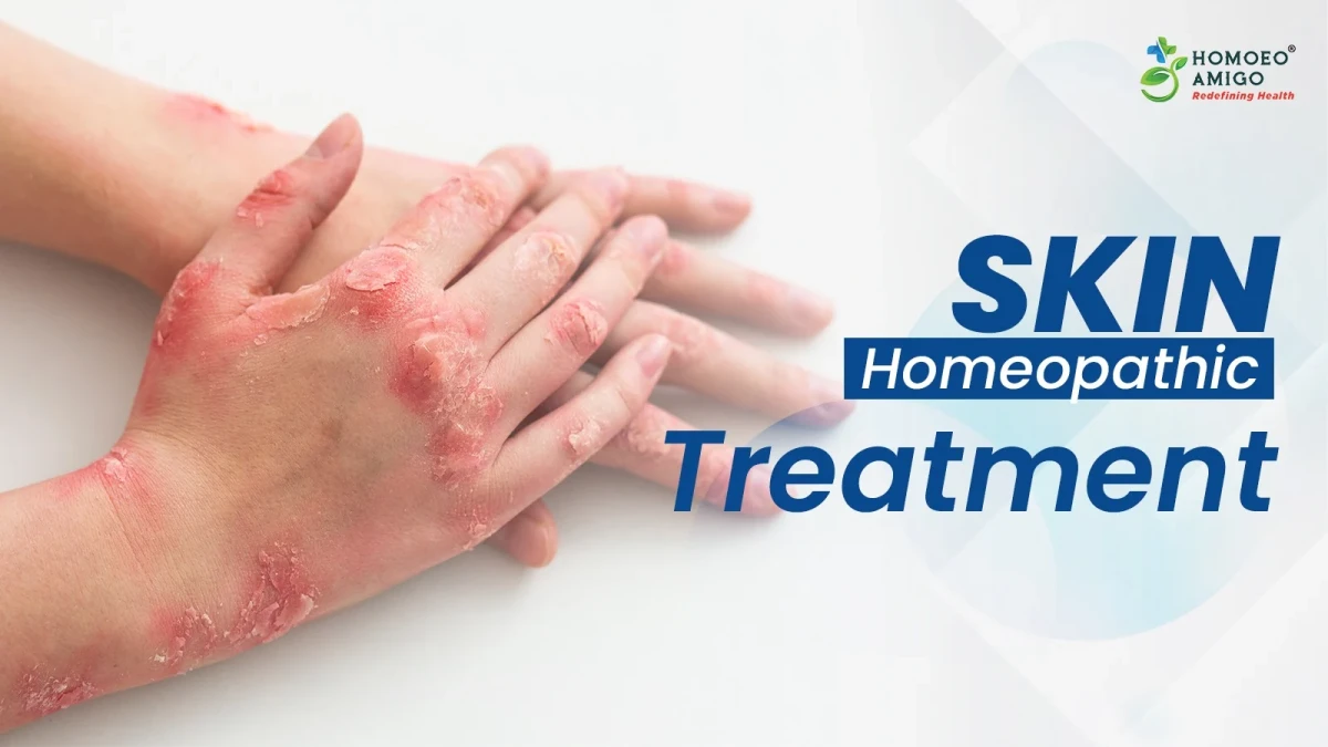 Skin Homeopathic Treatment