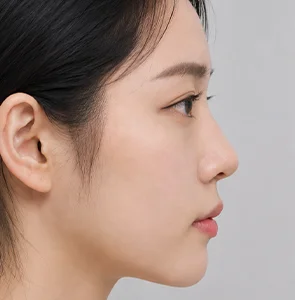 코성형 시술 전