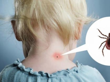 Врачи Сунженской центральной районной больницы подробно рассказали о Крымской геморрагической лихорадке (КГЛ)