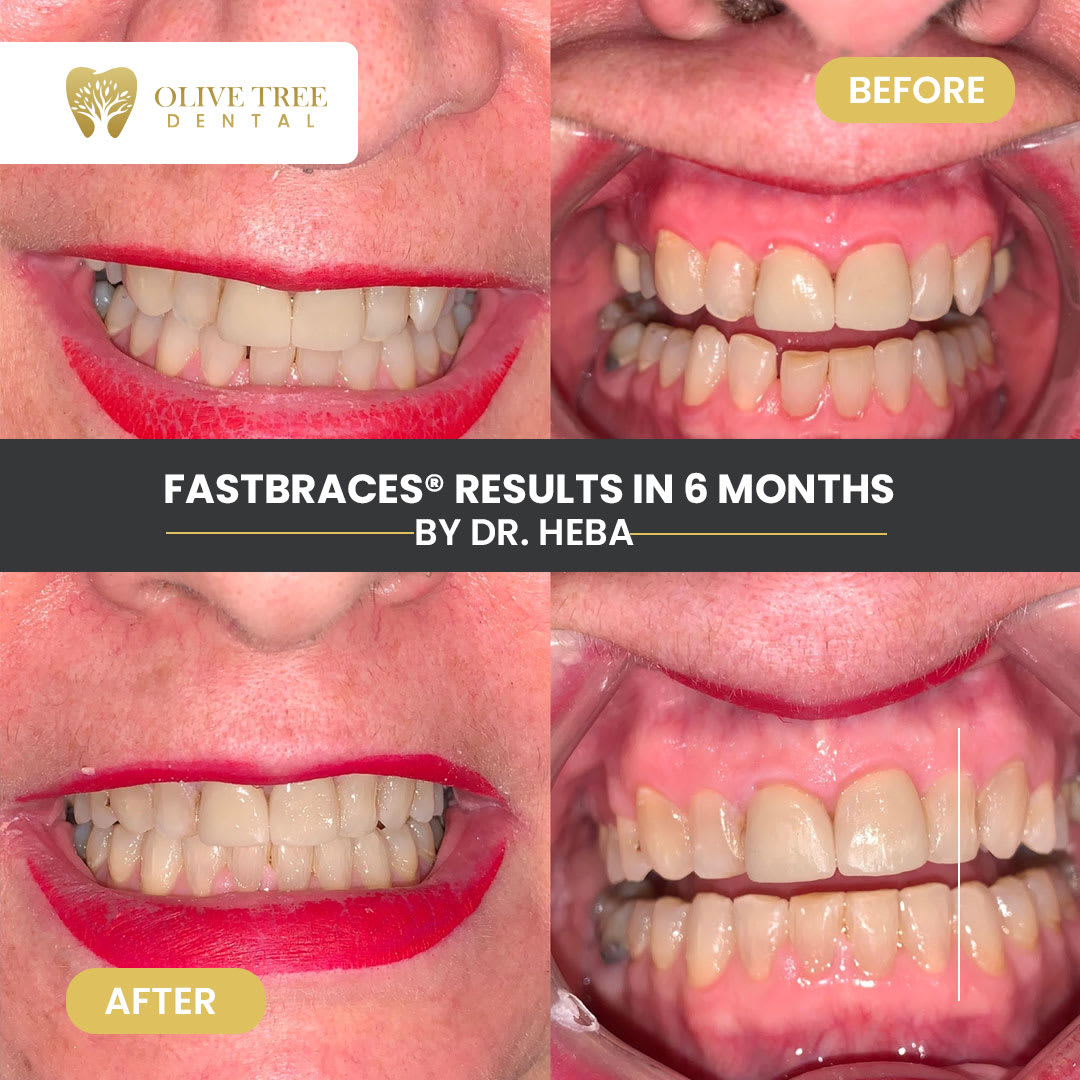 Dental Treatments Before & After Olive Tree Dental