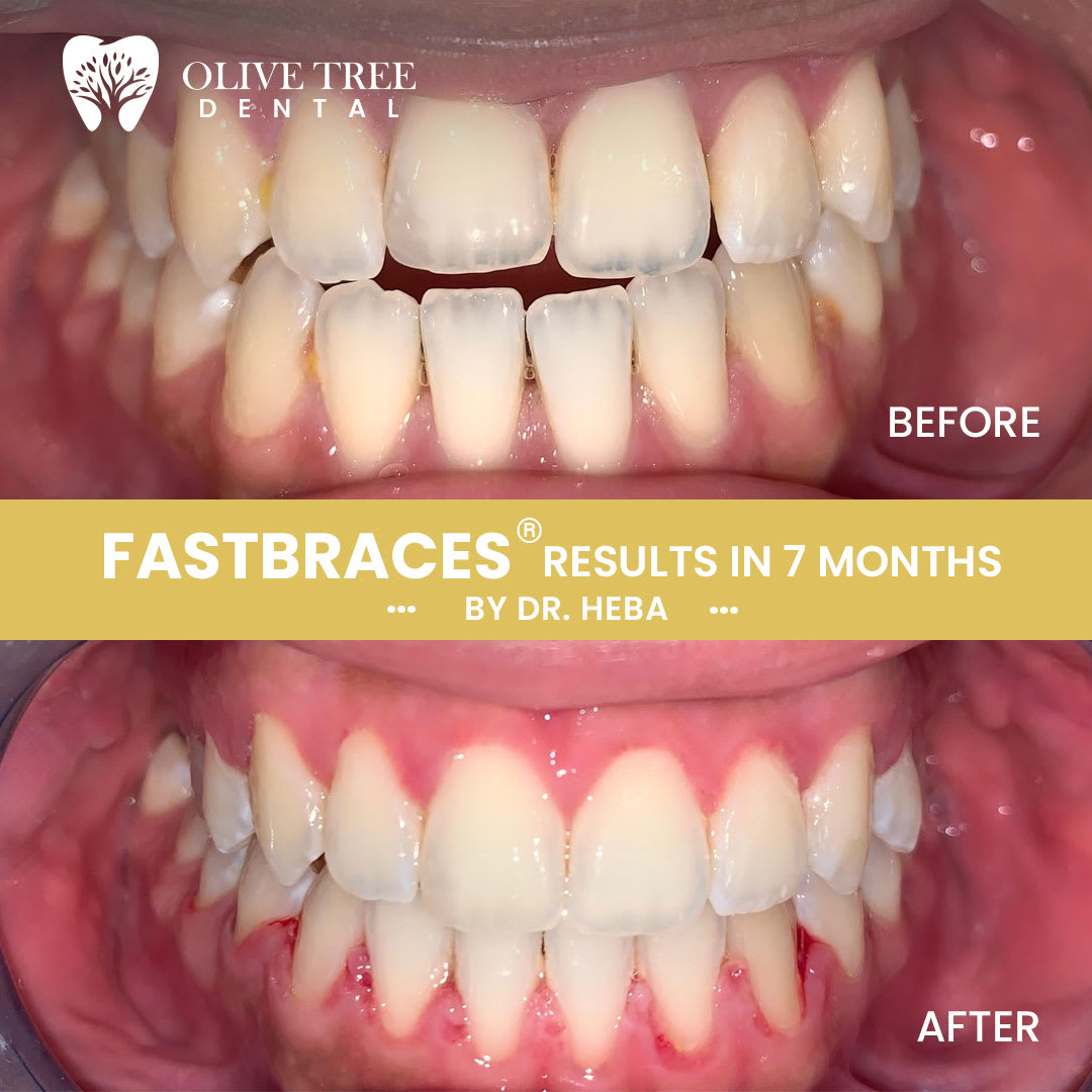 Dental Treatments Before & After Olive Tree Dental