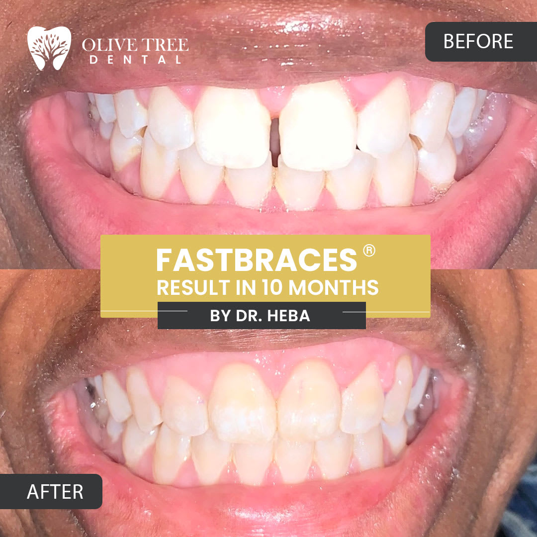 Dental Treatments Before & After Olive Tree Dental