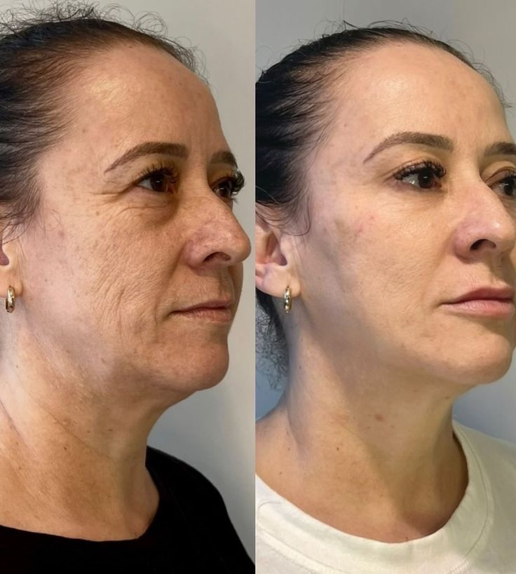 Antes y después visual de arrugas en perfil lateral