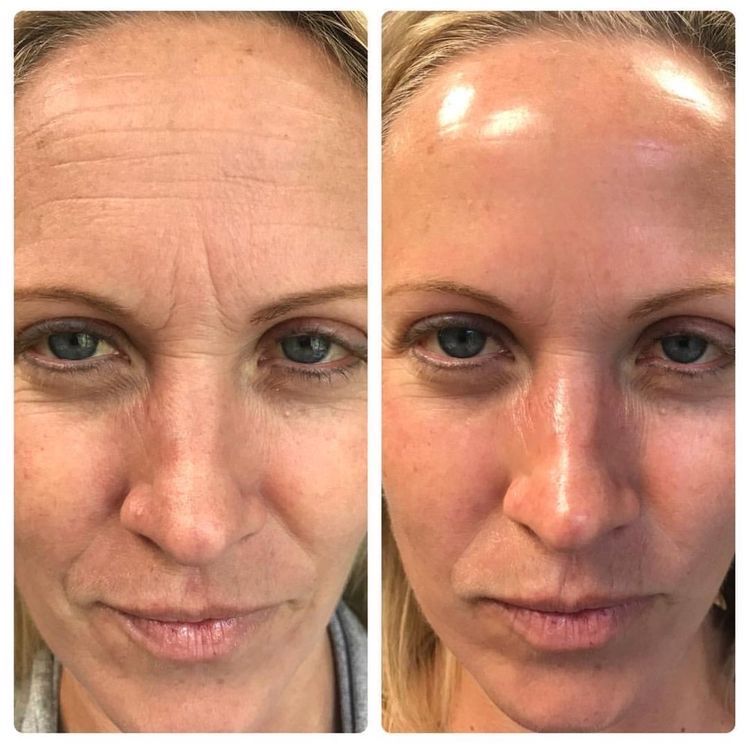 Antes y después visual de líneas alrededor de ojos y mejilla
