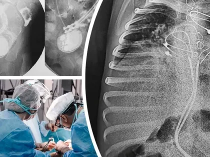 В Новосибирске хирурги спасли 3-летнего ребенка с кардиостимулятором в кишечнике