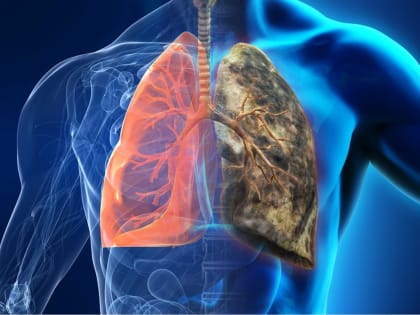 Неделя профилактики рака легких в России