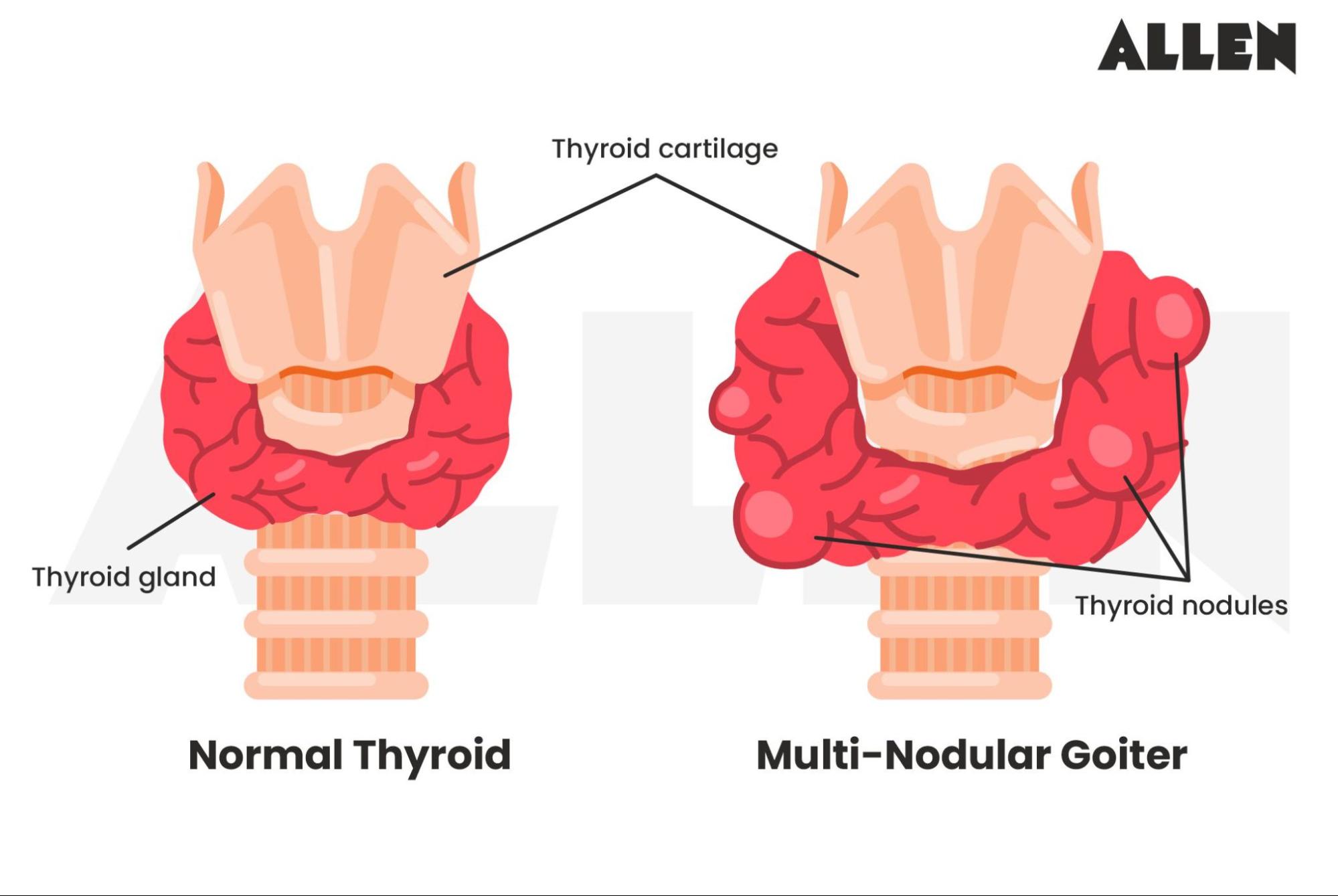 Multinodular Goiter