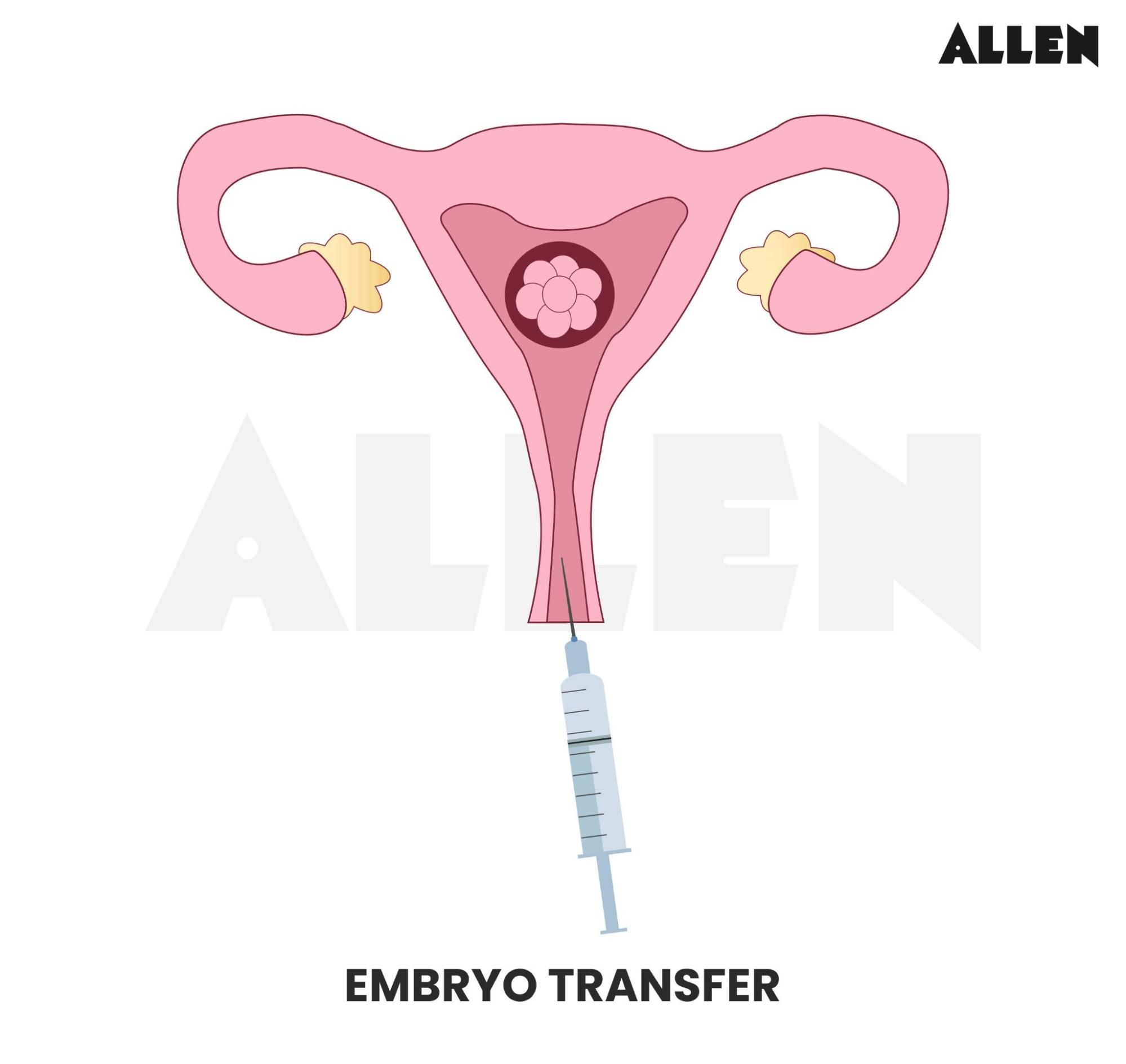 Diagram showing the transfer of an embryo into the uterus