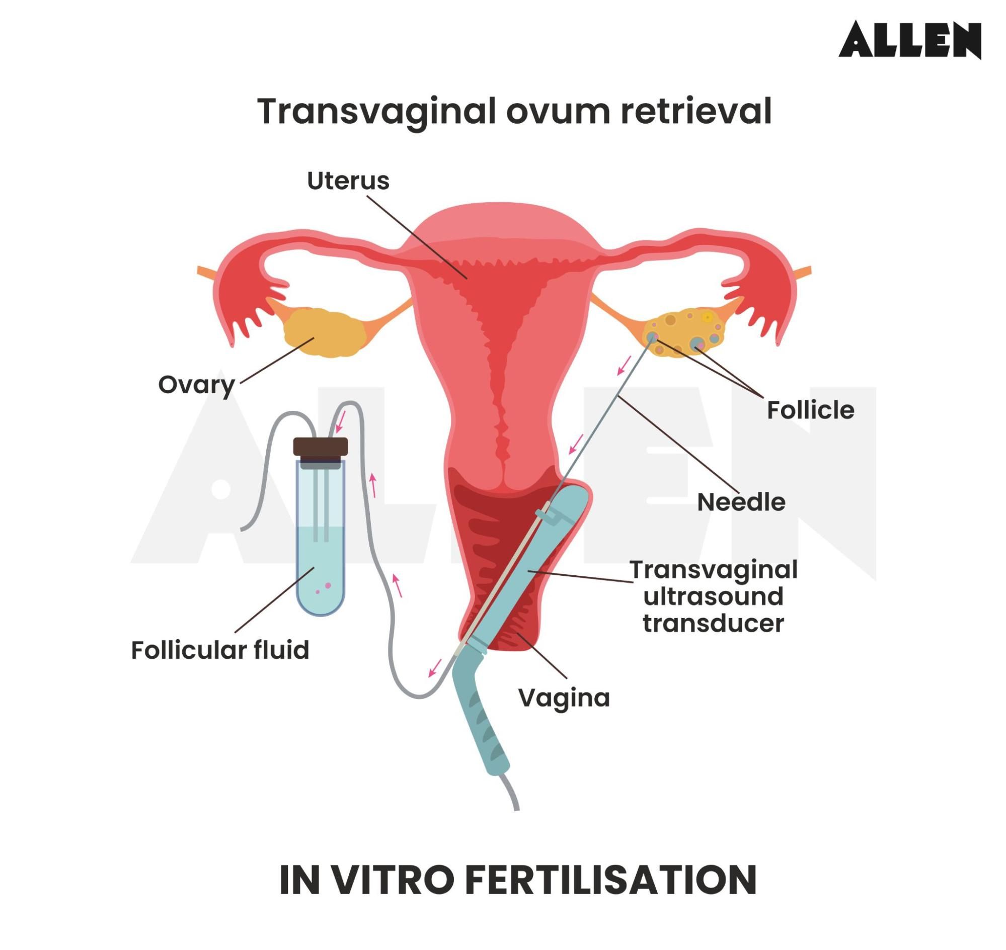 Diagram showing the transvaginal ovum retrieval for In Vitro Fertilization