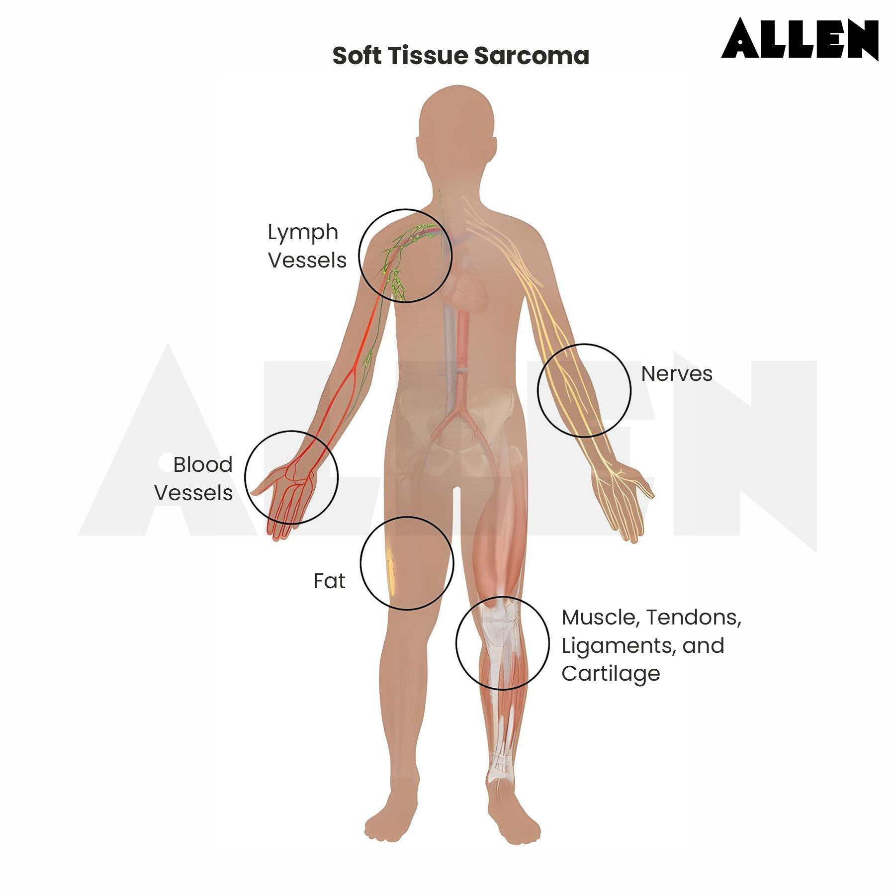 Soft Tissue Sarcoma