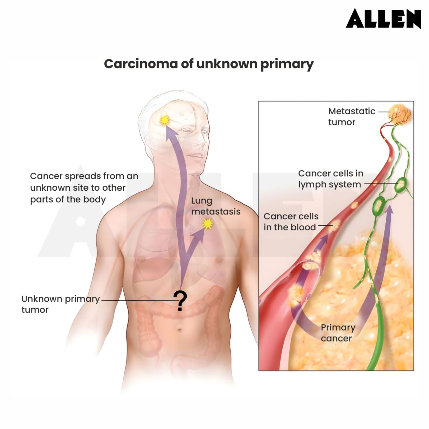 Carcinoma of unknown primary