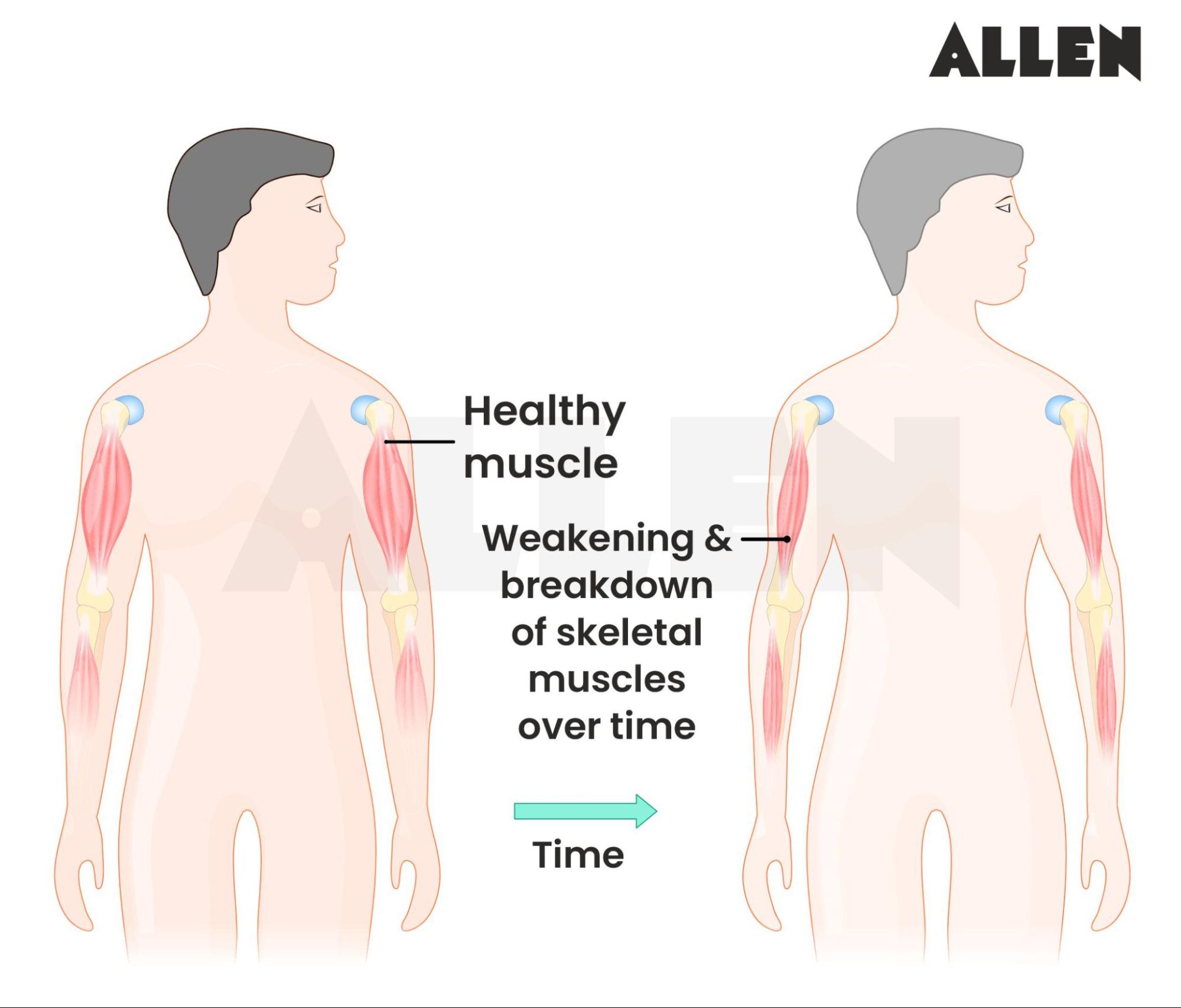 Muscular dystrophy