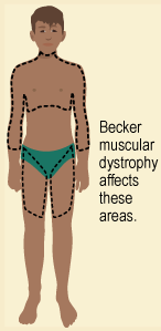 Becker Muscular Dystrophy (BMD)