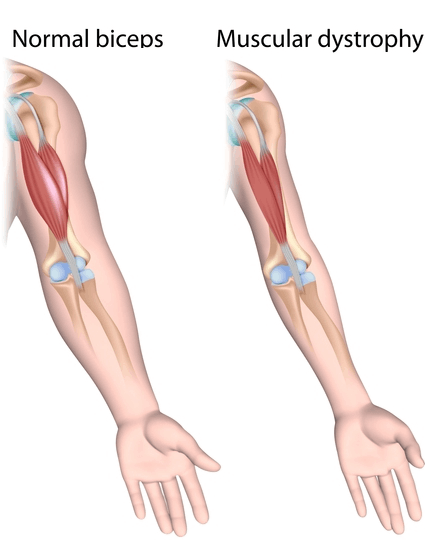 Muscular dystrophies
