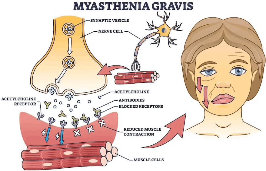 Myasthenia Gravis (MG)