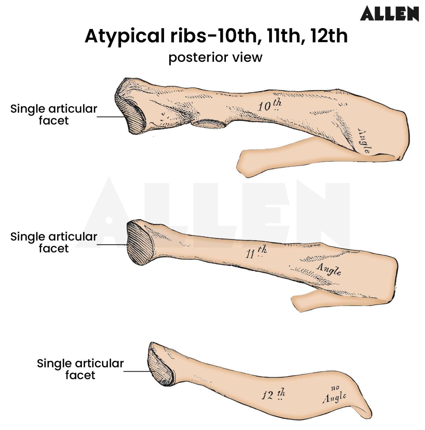 Atypical 10th 11th and 12th rib
