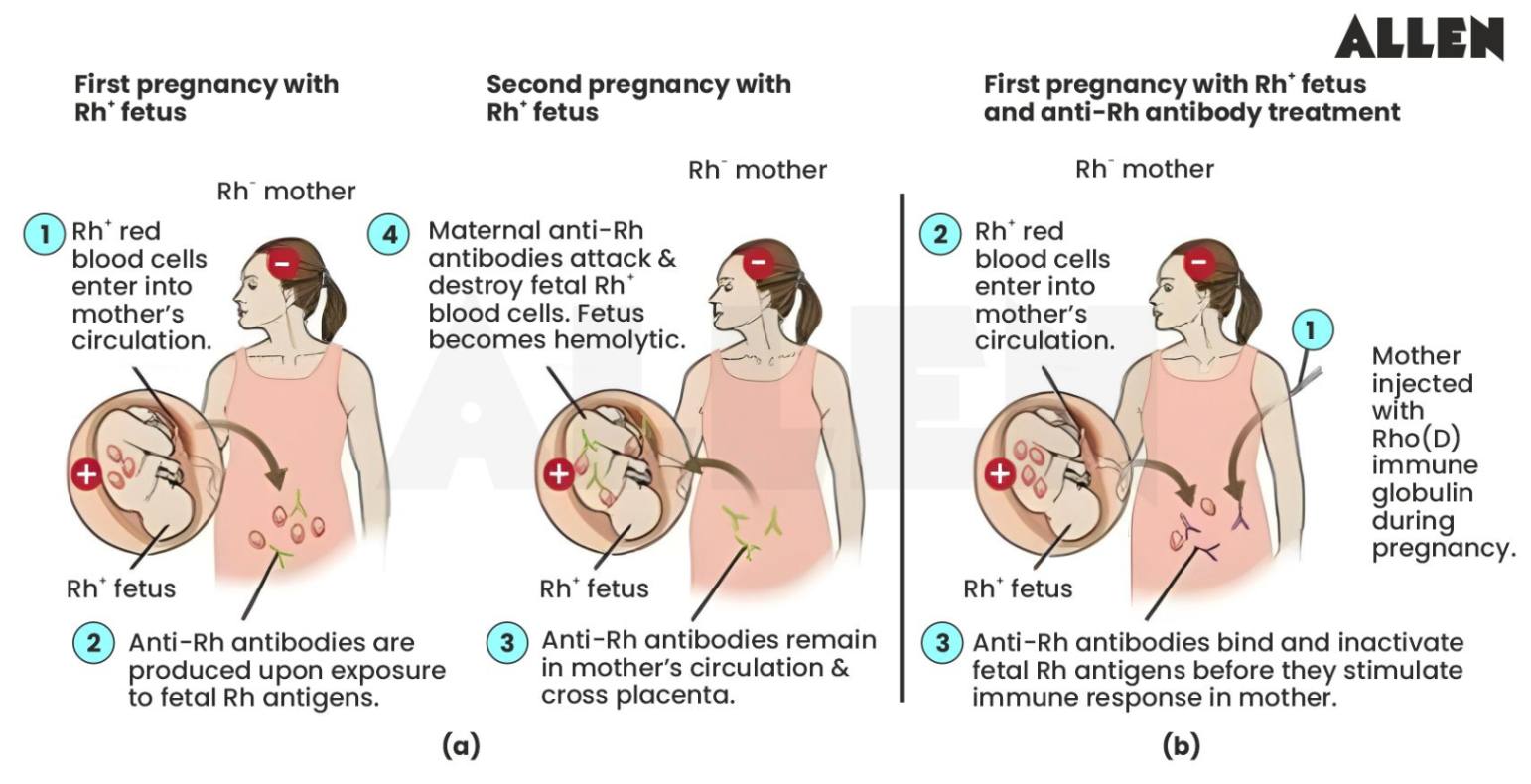 Rh Incompatibility
